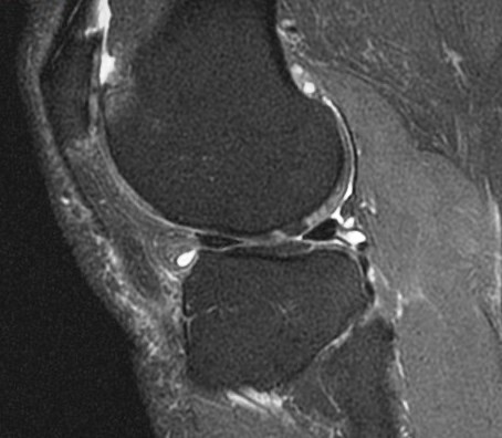 Figure 5 for case Button osteophyte filling chondral defect